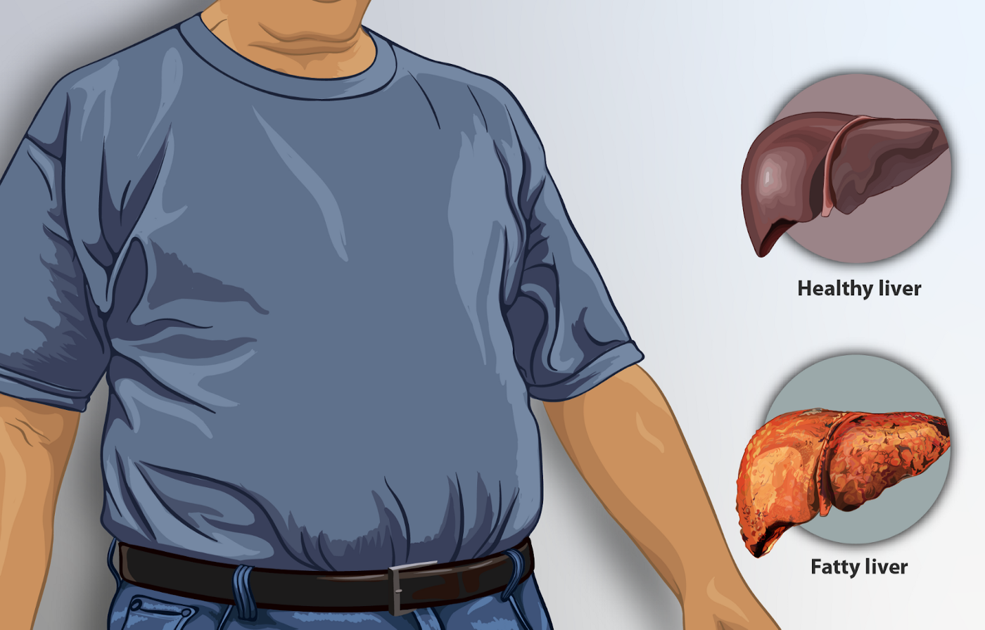 A vector image of a healthy liver and a fatty liver.