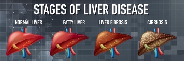Vector image of stages of liver disease and respective color of urine.
