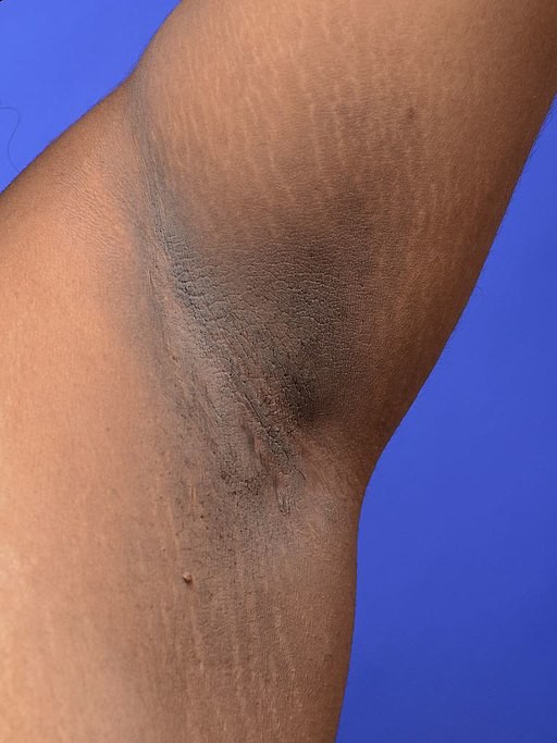 Darkened skin or darkened velvety patch on an underarm.