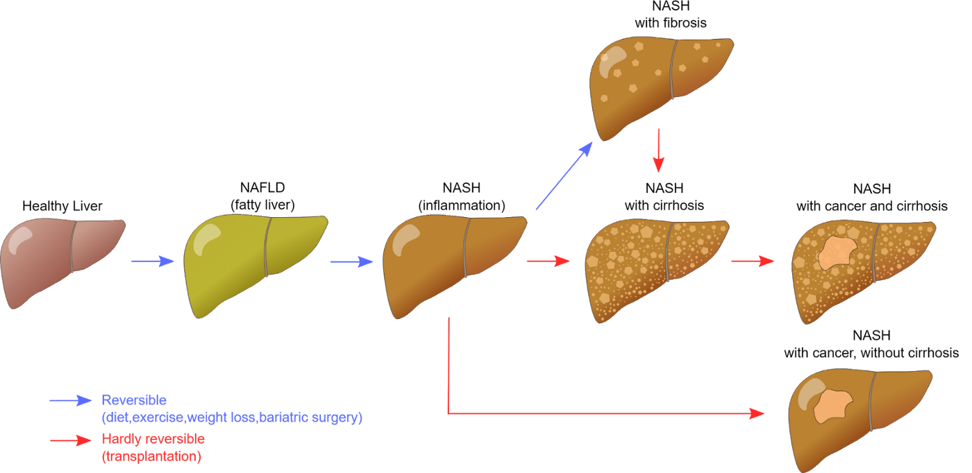 A vector image of different stages of fatty liver.